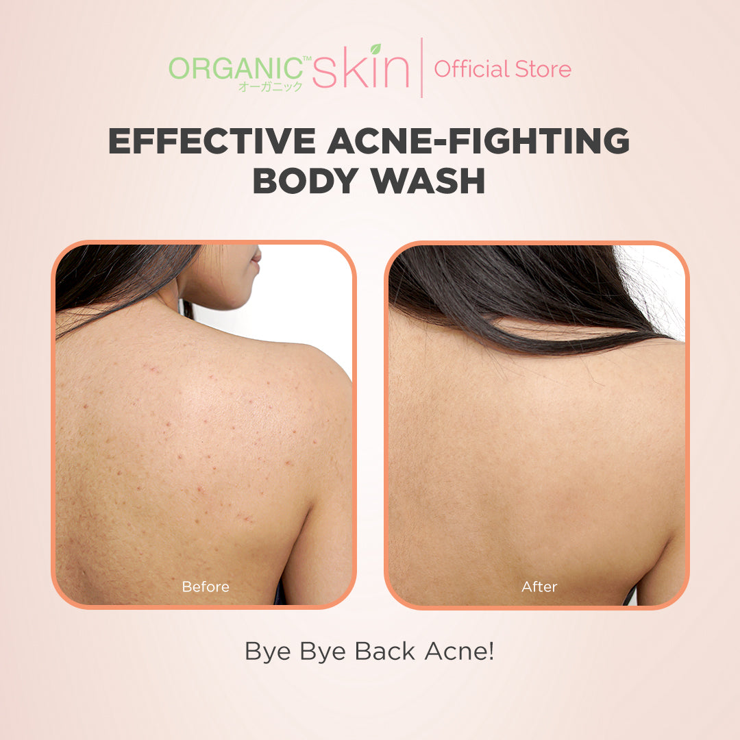 Organic Skin Japan Acne Care Bacne Body Wash 250ml Antiacne Bodywash Set of 2