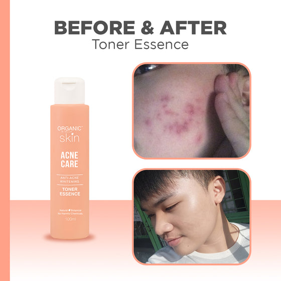 Organic Skin Japan Acne Care AntiAcne Whitening Toner Essence 100ml with Tea Tree Anti Acne