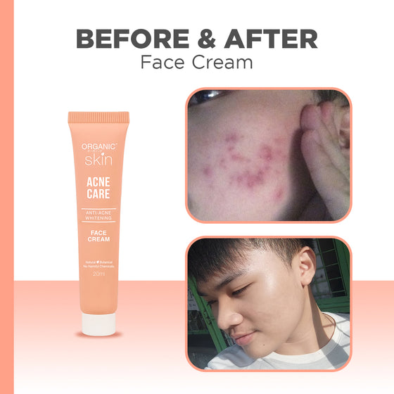 Organic Skin Japan Acne Care AntiAcne Whitening Face Cream 20ml Anti Acne