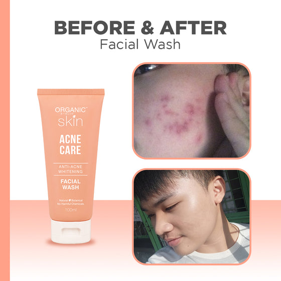 BUY 1 TAKE 1 Organic Skin Japan Acne Care Antiacne Whitening Facial Wash Cleanser 100ml Anti Acne