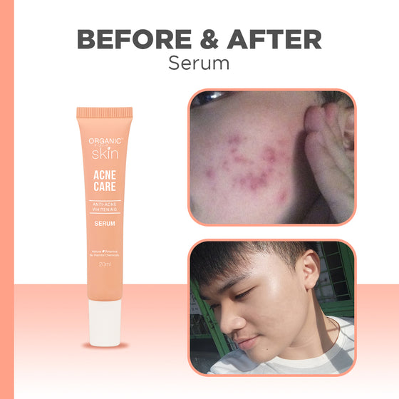 BUY 1 TAKE 1 Organic Skin Japan Acne Care AntiAcne Whitening Serum (20ml each) Anti Acne